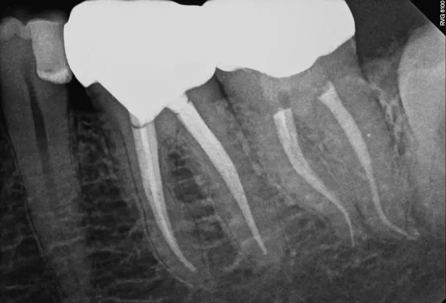 ENDODONCIA